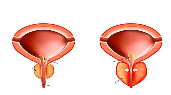 Normal and inflamed prostate