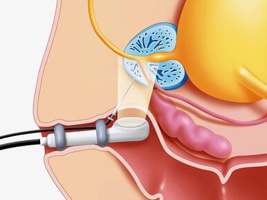 Drilling biopsy of the prostate gland