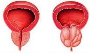 Healthy and inflamed prostate